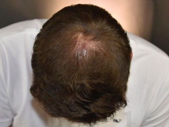 FUE Hair Restoration: Case 19 - After