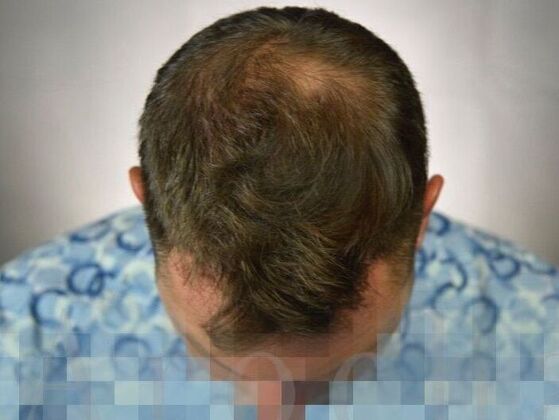 FUE Hair Restoration: Case 19 - Before