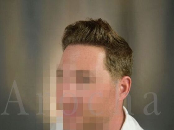 FUE Hair Restoration: Case 19 - After