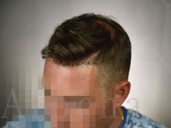 FUE Hair Restoration: Case 19 - Before