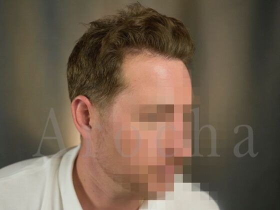 FUE Hair Restoration: Case 19 - After