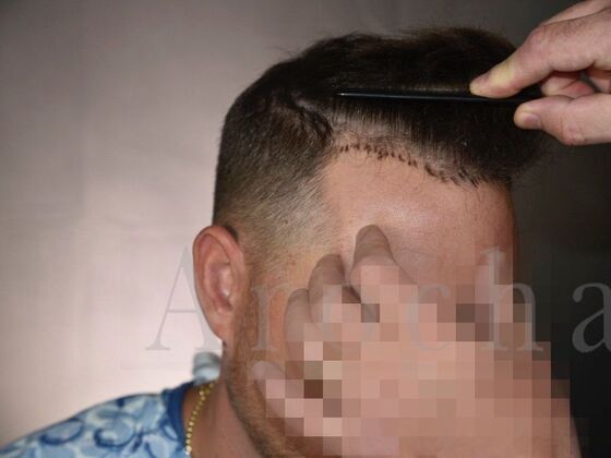 FUE Hair Restoration: Case 19 - Before