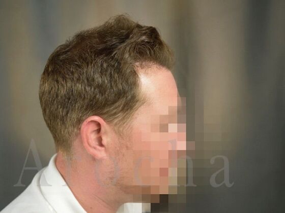 FUE Hair Restoration: Case 19 - After