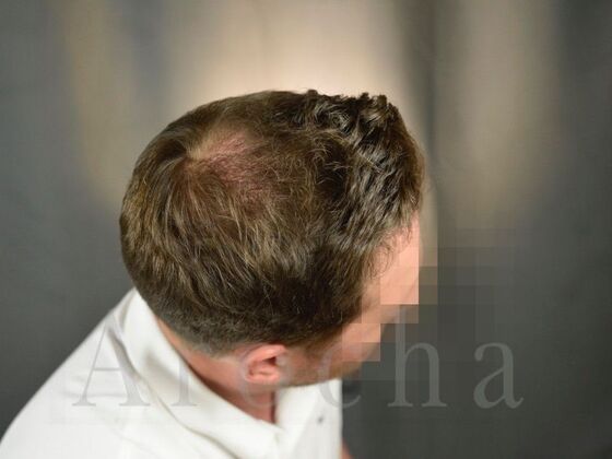 FUE Hair Restoration: Case 19 - After