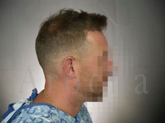 FUE Hair Restoration: Case 19 - Before