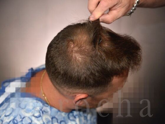 FUE Hair Restoration: Case 19 - Before