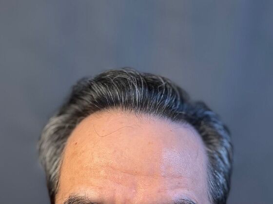 FUE Hair Restoration: Case 20 - After