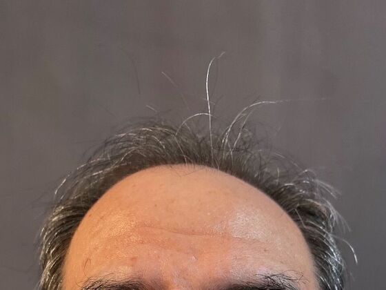 FUE Hair Restoration: Case 20 - Before