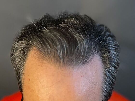 FUE Hair Restoration: Case 20 - After