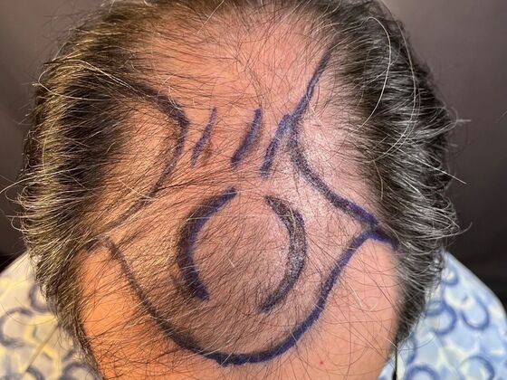 FUE Hair Restoration: Case 20 - Before