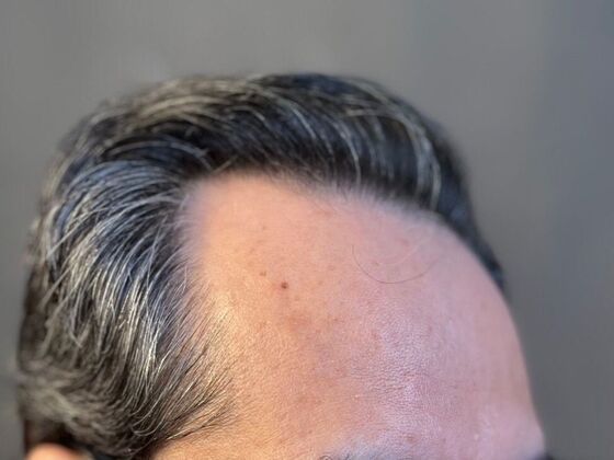 FUE Hair Restoration: Case 20 - After