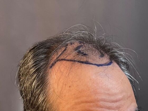 FUE Hair Restoration: Case 20 - Before