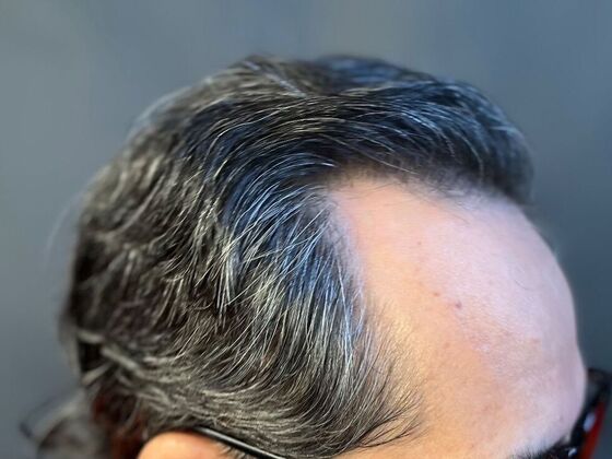 FUE Hair Restoration: Case 20 - After