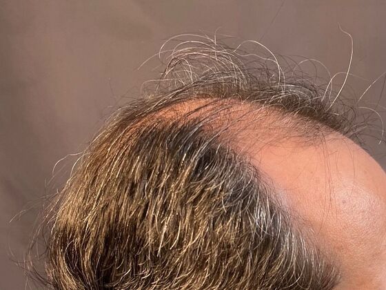 FUE Hair Restoration: Case 20 - Before