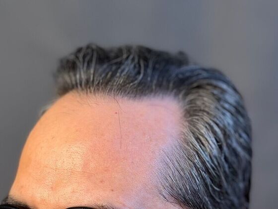 FUE Hair Restoration: Case 20 - After