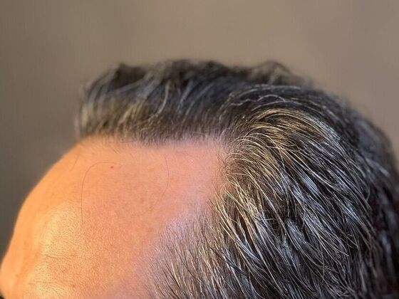 FUE Hair Restoration: Case 20 - After