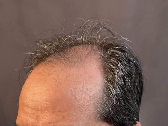 FUE Hair Restoration: Case 20 - Before