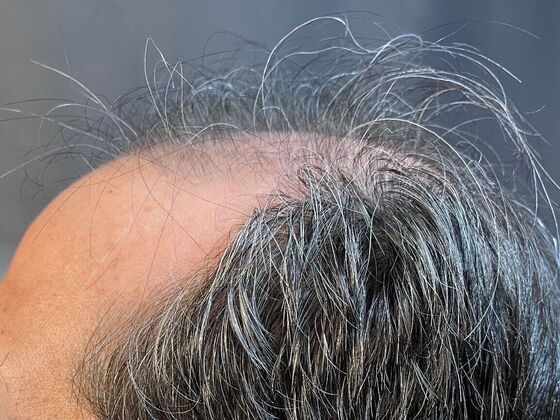 FUE Hair Restoration: Case 20 - Before