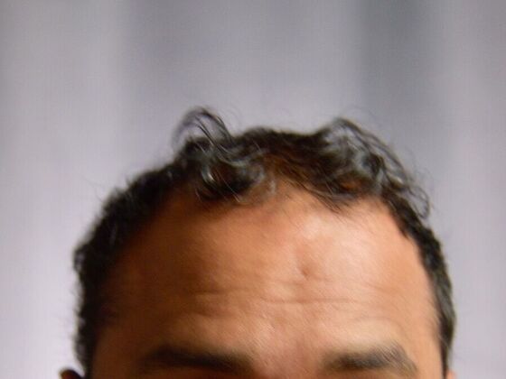 FUE Hair Restoration: Case 7 - Before