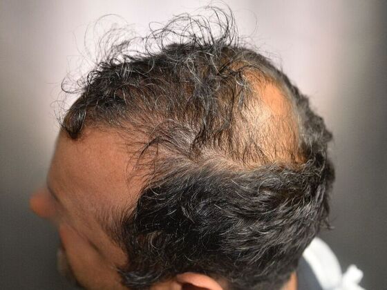 FUE Hair Restoration: Case 7 - Before