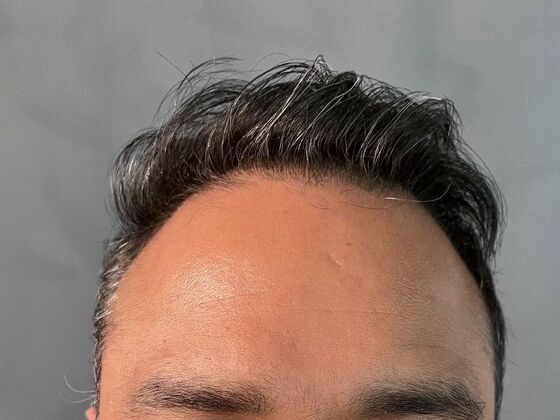 FUE Hair Restoration: Case 7 - After