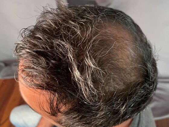 FUE Hair Restoration: Case 7 - After