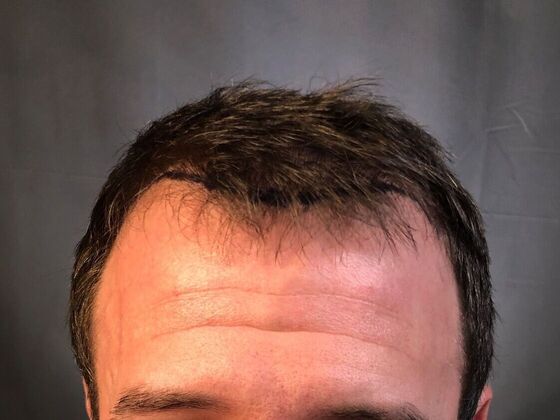 FUE Hair Restoration: Case 21 - Before