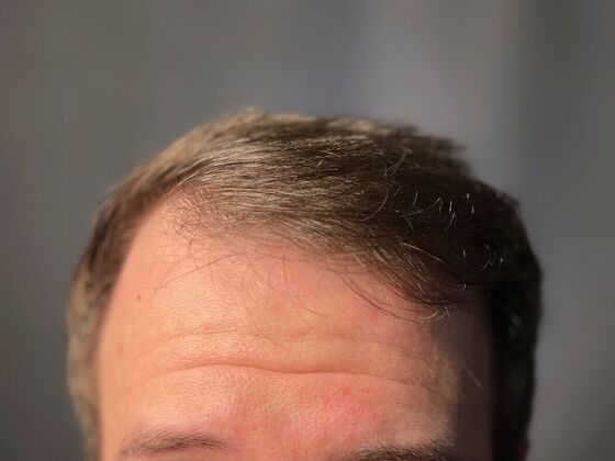 FUE Hair Restoration: Case 21 - After