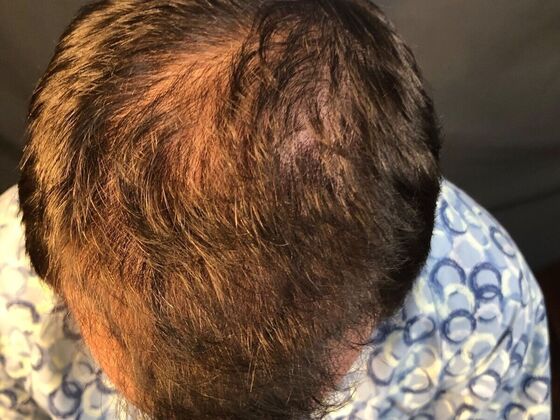 FUE Hair Restoration: Case 21 - Before