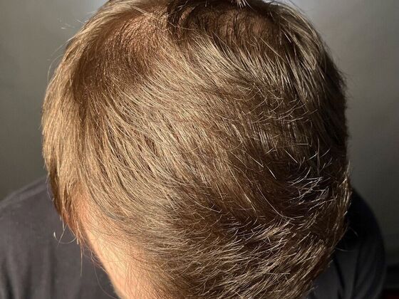 FUE Hair Restoration: Case 21 - After