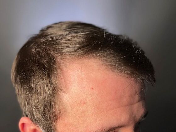 FUE Hair Restoration: Case 21 - After