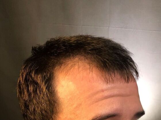 FUE Hair Restoration: Case 21 - Before