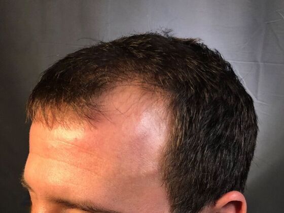 FUE Hair Restoration: Case 21 - Before