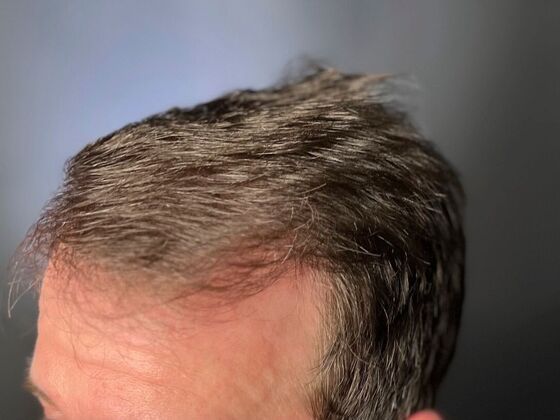 FUE Hair Restoration: Case 21 - After