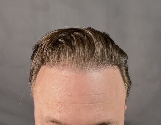 Corrective Hair Restoration Cases