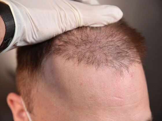 Corrective Hair Restoration: Case 1 - Before