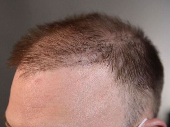 Corrective Hair Restoration: Case 1 - Before