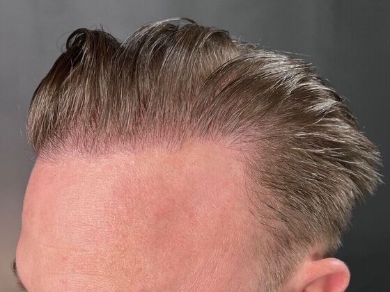 Corrective Hair Restoration: Case 1 - After