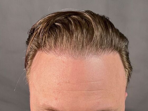 Corrective Hair Restoration Case 1 - After