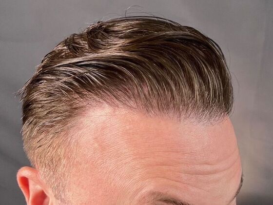 Corrective Hair Restoration: Case 1 - After