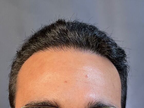Corrective Hair Restoration Case 2 - After