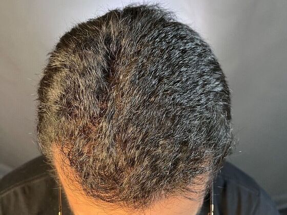 Corrective Hair Restoration: Case 2 - After