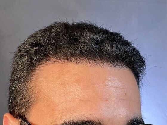 Corrective Hair Restoration: Case 2 - After