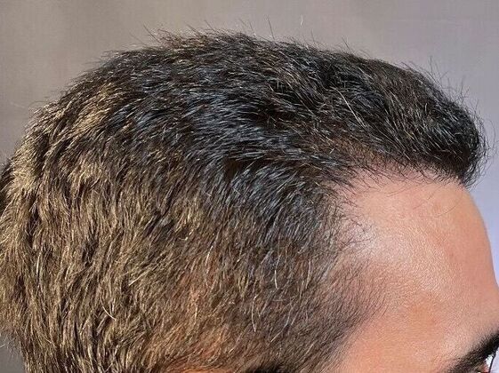 Corrective Hair Restoration: Case 2 - After