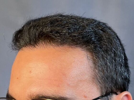 Corrective Hair Restoration: Case 2 - After