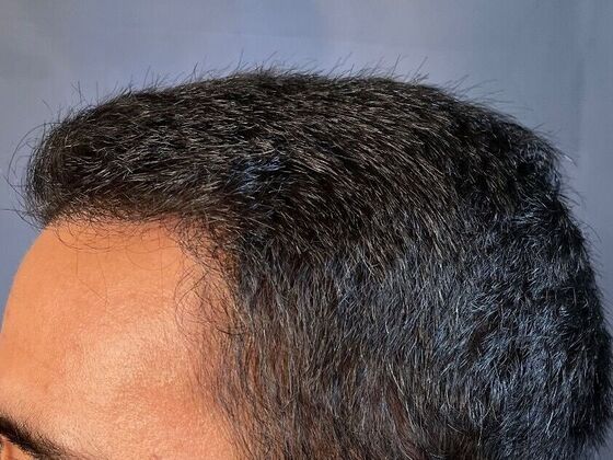 Corrective Hair Restoration: Case 2 - After