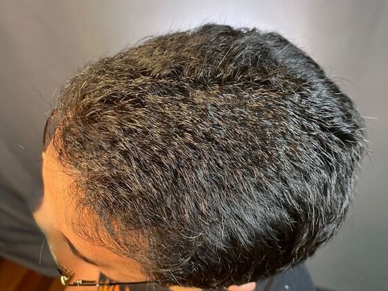 Corrective Hair Restoration: Case 2 - After