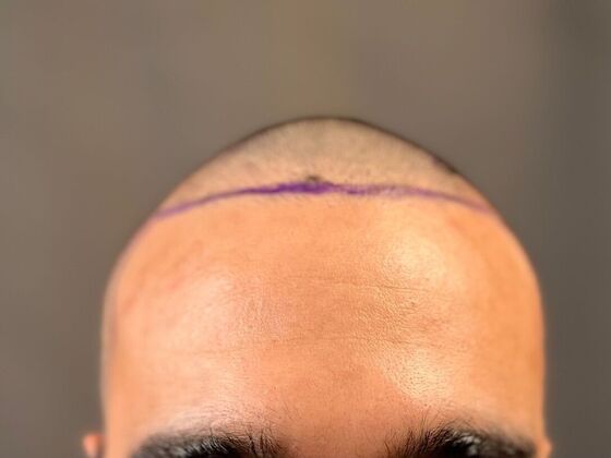 Corrective Hair Restoration Case 2 - Before