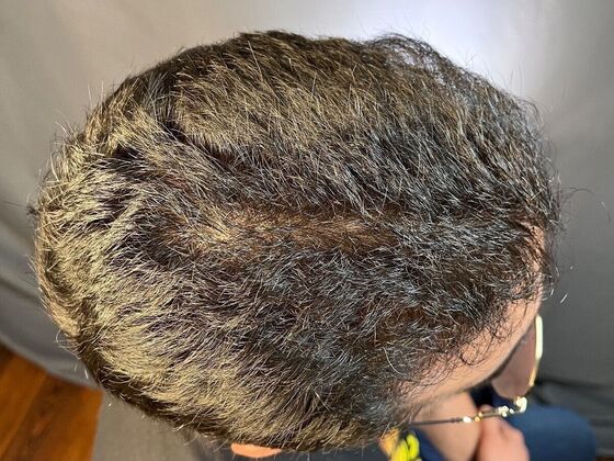 Corrective Hair Restoration: Case 2 - After