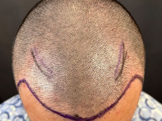 Corrective Hair Restoration: Case 2 - Before